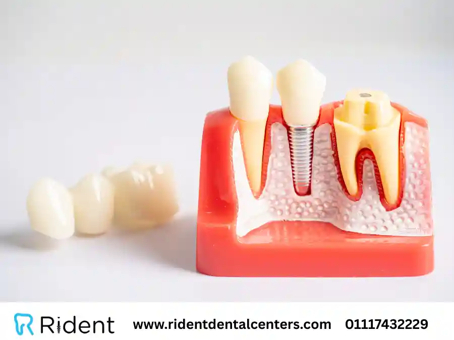 زرع الاسنان وأنواعه وأسعاره 2025